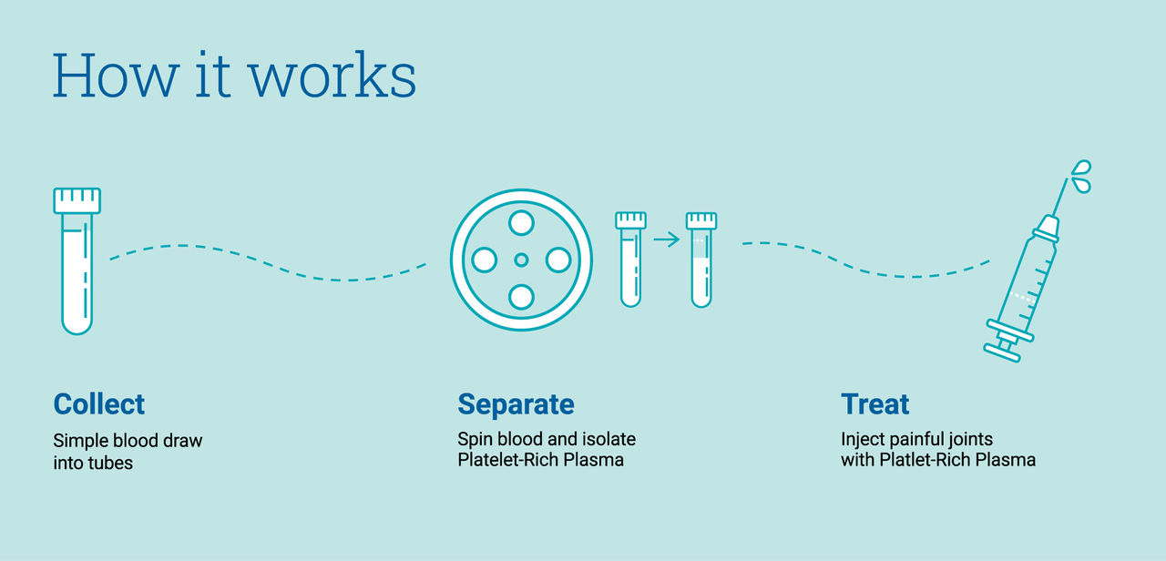 how platelet-rich plasma therapy works from collection of blood into tubes, then separated by spinning the blood and islating the platelet-rich plasma, and then injecting the painful joints with the plasma