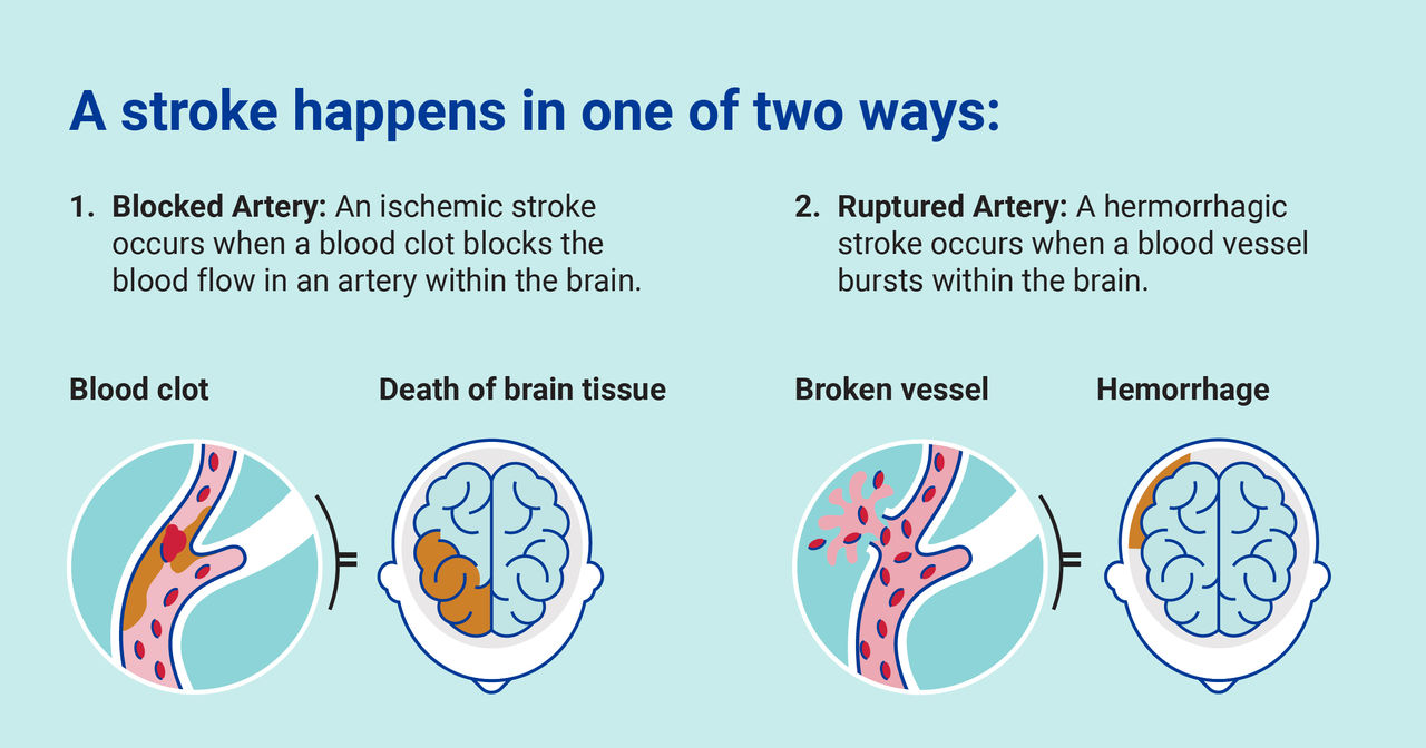 Diagram of ischemic stroke vs. hemorrhagic stroke