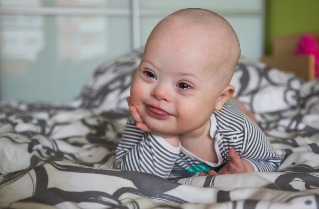 Baby with Down Syndrome