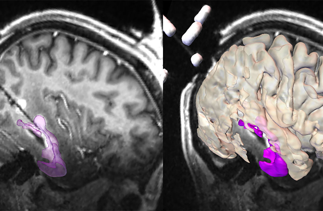 Antibody Therapy Inspired by Patient Case Reduced Tau Tangles in a Preclinical Model of Alzheimer’s Disease