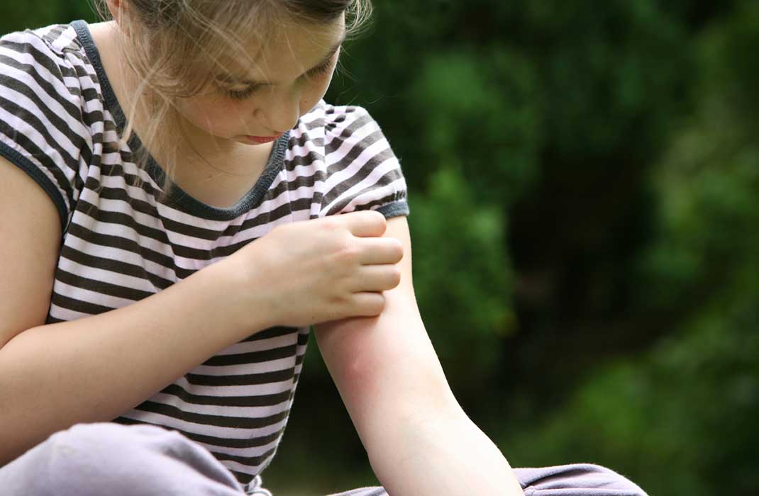 How to Care for Insect and Bug Bites